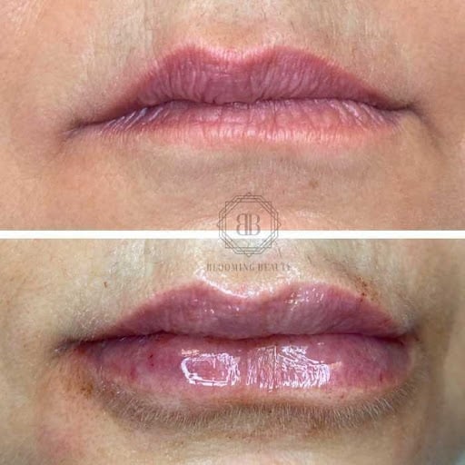 Lip Filler Aftercare - b clinic