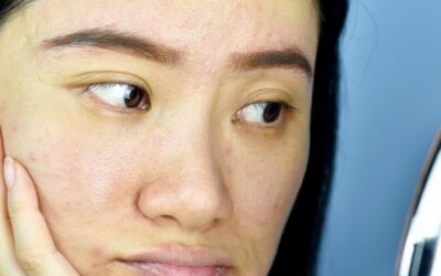 Chemical Peel for Acne Scars: How it Works